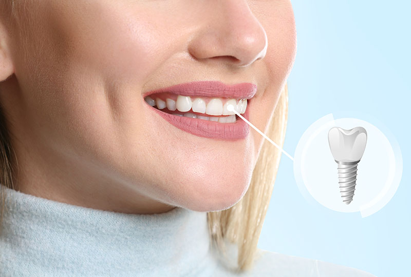 The image features a smiling woman with a toothpaste-like substance on her teeth, accompanied by an illustration of a toothbrush and dental implant in the upper right corner, suggesting oral hygiene or dental care theme.